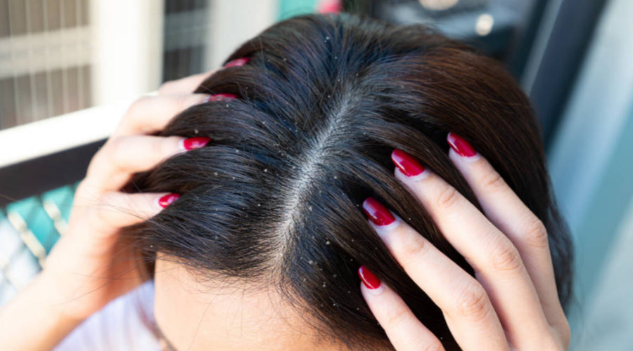 Why Do I Have Dandruff All of a Sudden?