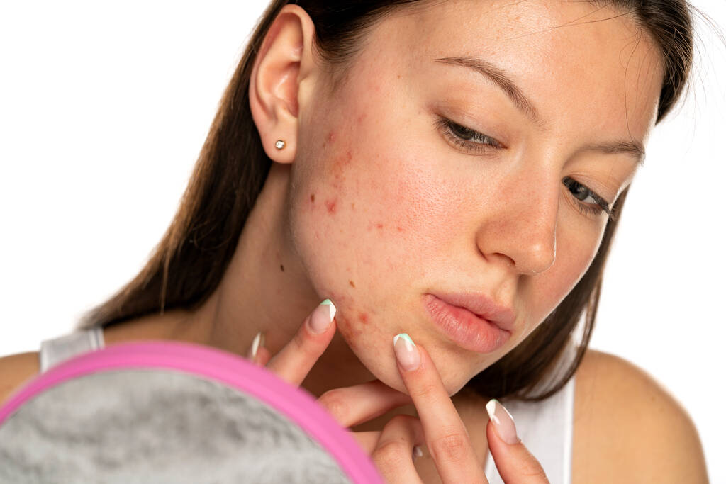 Fungal Acne vs Bacterial Acne vs Hormonal Acne