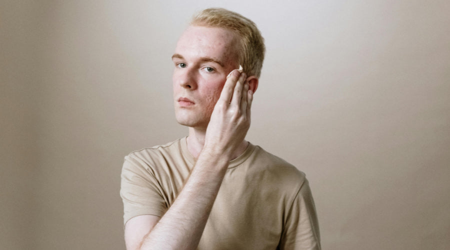 Tips on Choosing a Moisturiser for Acne-Prone Skin