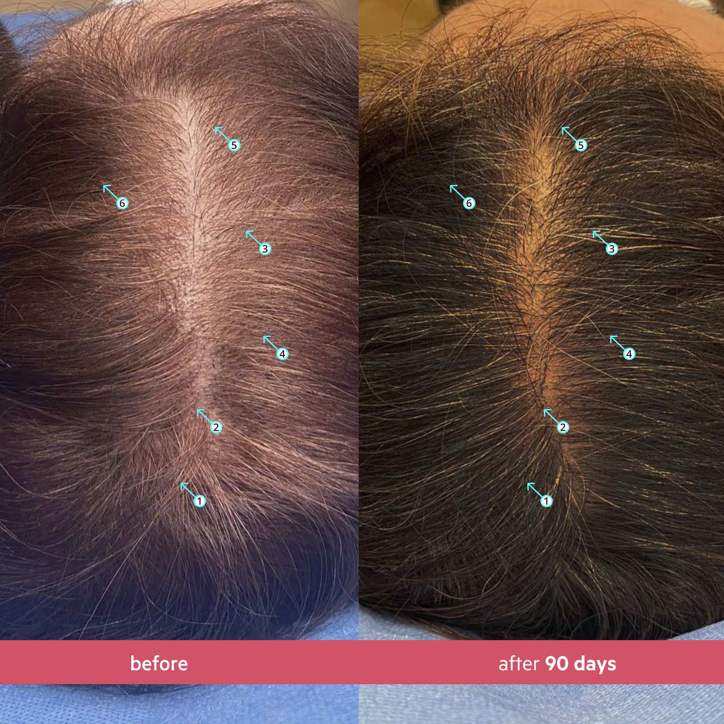Spectral Women's (CSF) Breakthrough Hair Revitalizing System for Women with Nanoxidil 5%